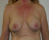 Feel Beautiful - Breast Revision San Diego 17 - Before Photo